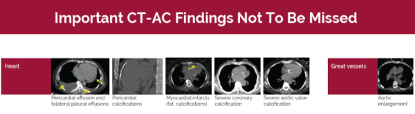Hybrid Imaging CT-AC Findings_Poster preview