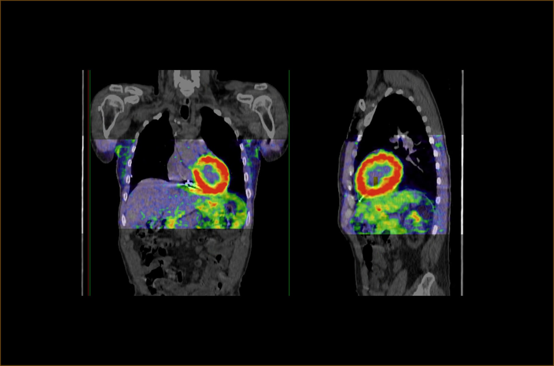 PET scan image showing lung cancer with highlighted tumor regions.